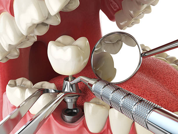 Best Cracked Tooth Emergency Dentist  in Kennesaw, GA